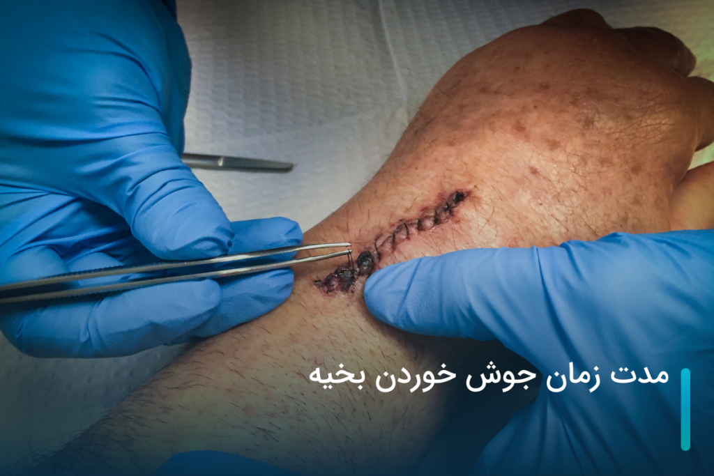 مدت زمان جوش خوردن بخیه