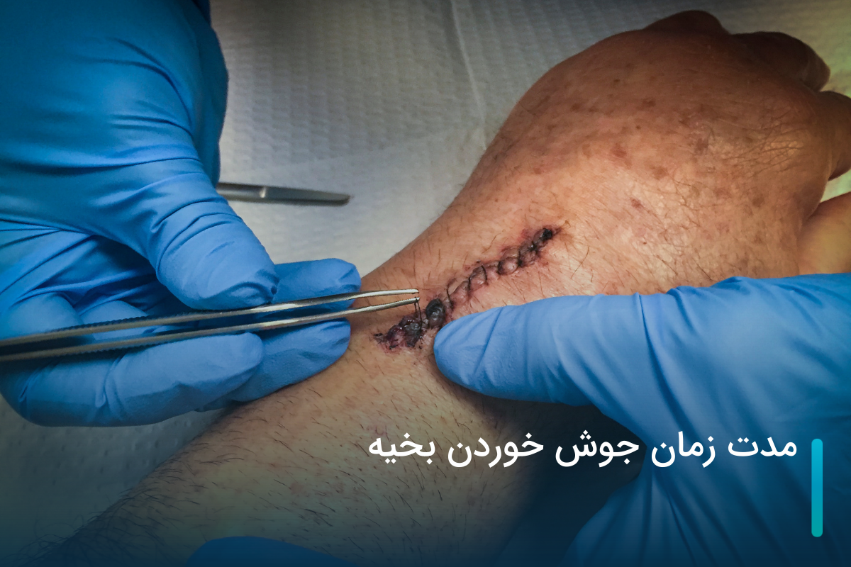 مدت زمان جوش خوردن بخیه
